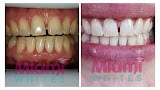 Miami Whites Teeth Whitening — dentist in Miami